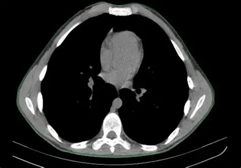 воронкообразная грудь